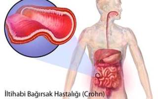 Ýltihabi Baðýrsak Hastalýðý